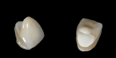 完成したオールセラミックの表と裏