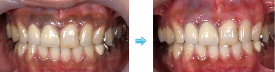 メラニン色素除去工程