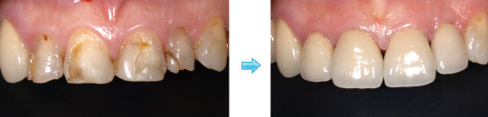 メタルボンド装着前後