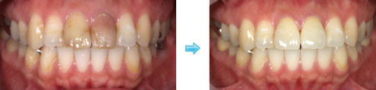 オールセラミッククラウン症例