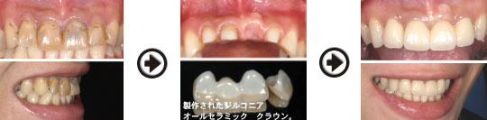 製作されたジルコニアオールセラミック クラウン