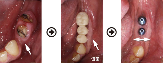 �C���v�����g����(�f�a�q�j�ߒ�