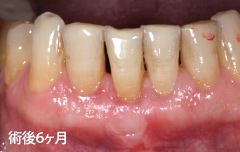 術後1ヶ月