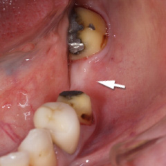 �u���b�W���O�������